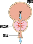 肥大した前立腺が内側にある尿道を圧迫する
