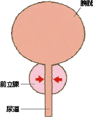 前立腺が肥大し始めると膀胱や尿道が刺激され、スムーズな排尿が難しくなってきます。