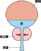 さらに前立腺が肥大すると、尿道が狭くなって排出されない尿が膀胱に残ってきます。
