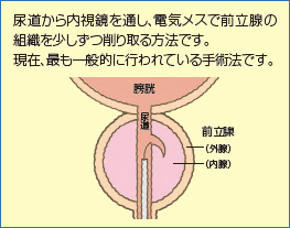 尿道から内視鏡を通し、電気メスで前立腺の組織を少しずつ削り取る方法です。現在最も一般的に行われている手術法です。